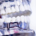 Implant dentystyczny - proces umieszczania implantu dentystycznego