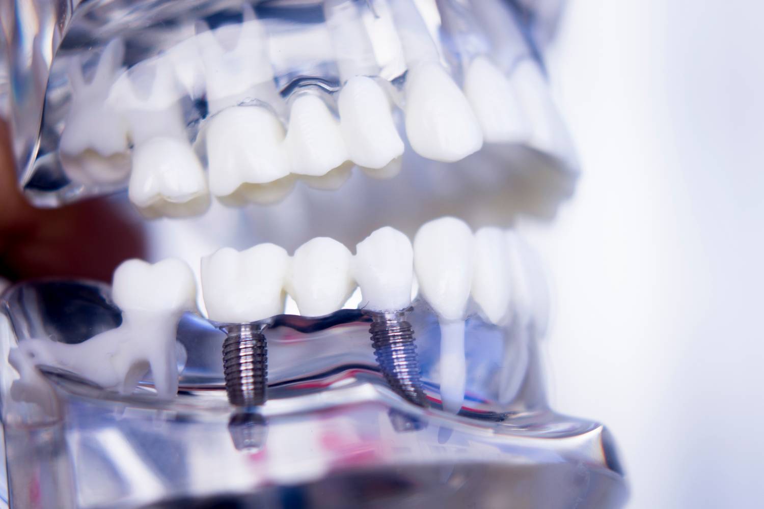 Implant dentystyczny - proces umieszczania implantu dentystycznego