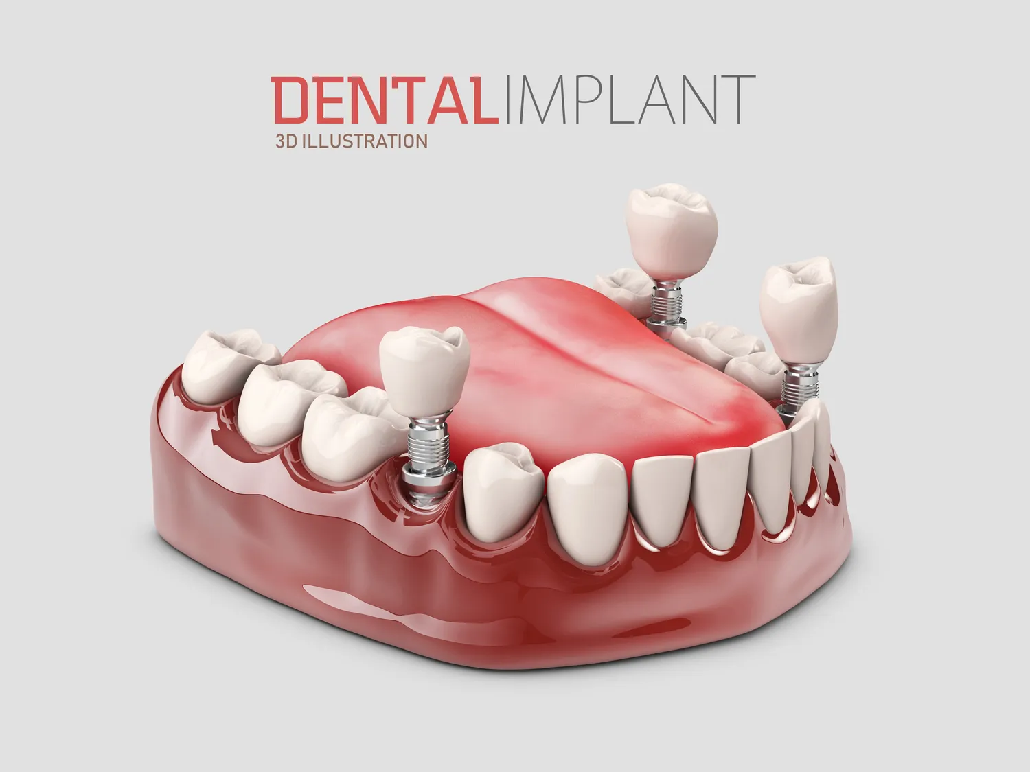 Dentysta Warszawa implanty