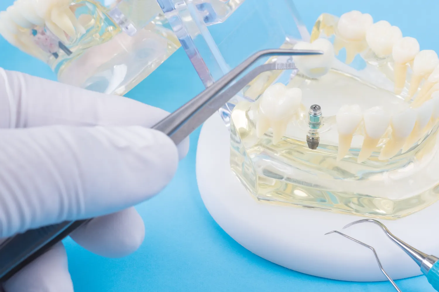 Rodzaje implantów zębowych